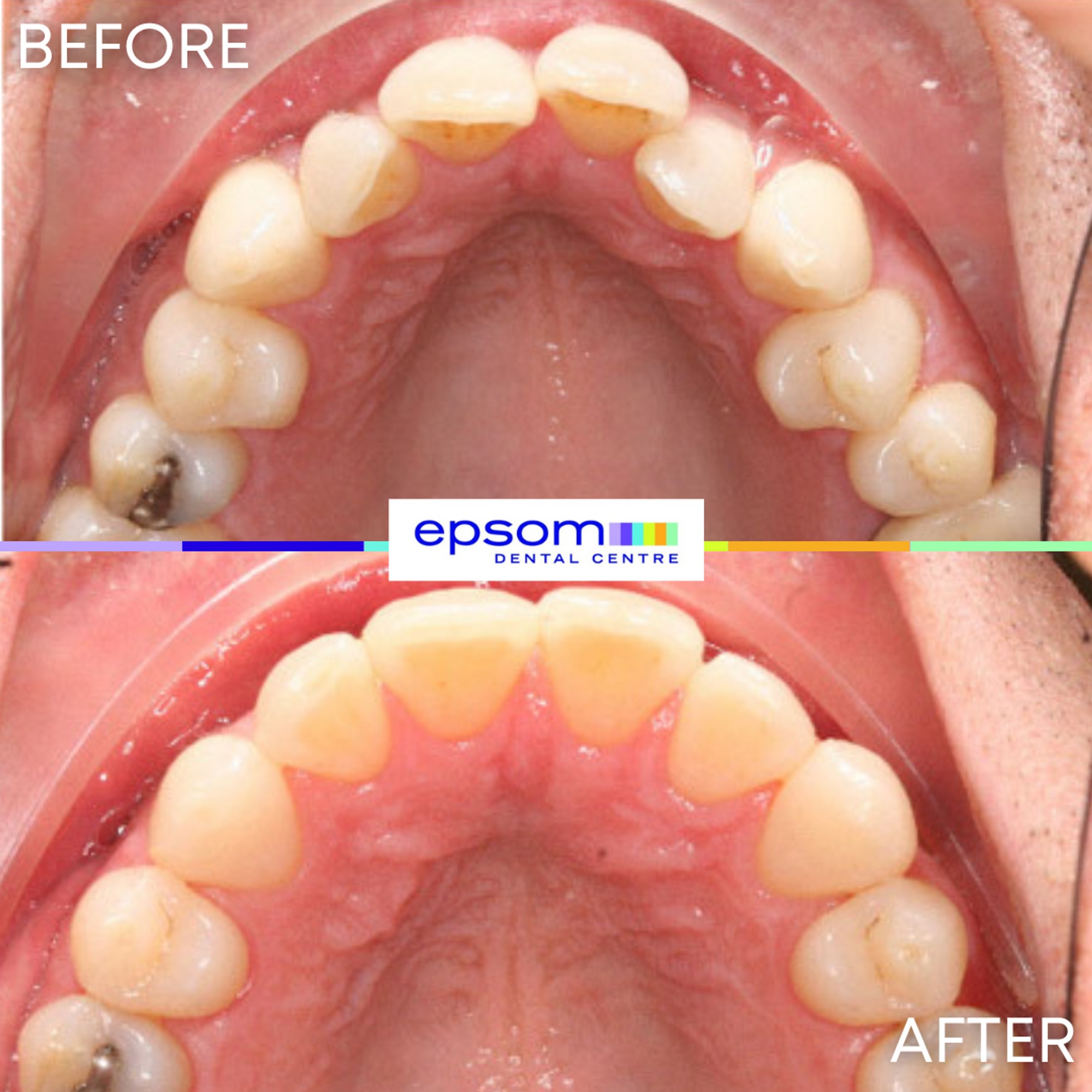 Before and after treatment