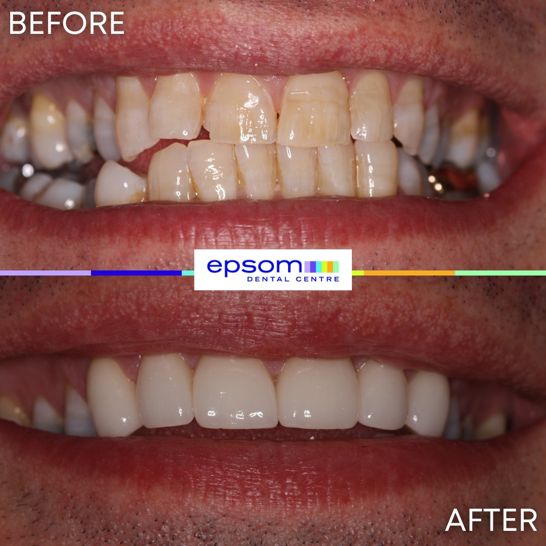 Before and after treatment